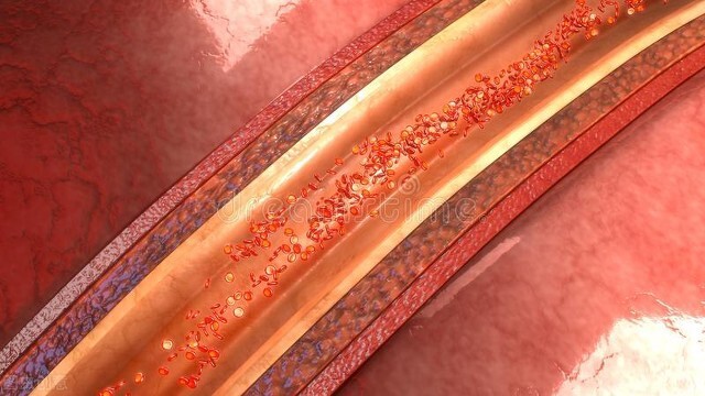 脑梗|血管“刮油机”已公布，不是山楂，平时敞开吃，隔天一通到底