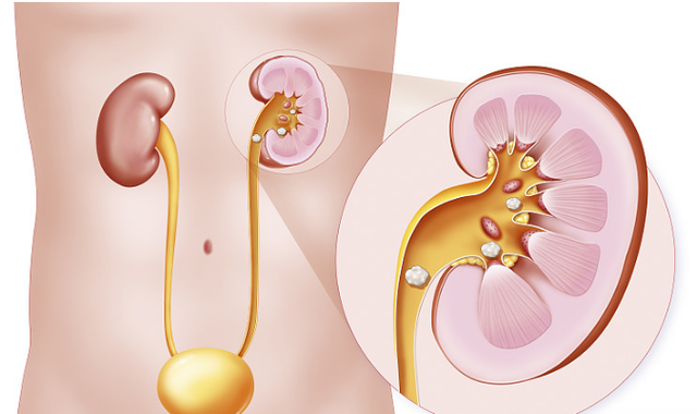 肾结石|解读：肾结石经治疗后，仍然反复发作，难道是遇到了黑心医生？
