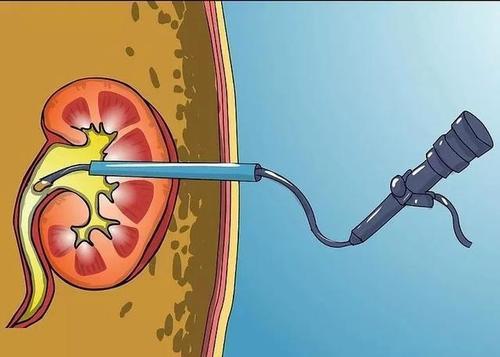 肾结石|解读：肾结石经治疗后，仍然反复发作，难道是遇到了黑心医生？