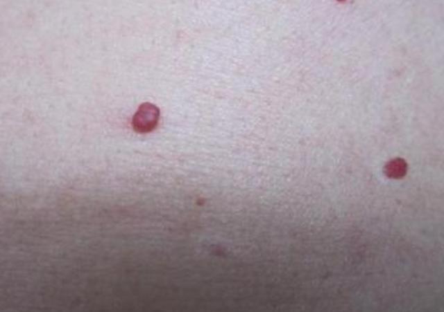 癌细胞|身体出现的3个“怪象”，可能是癌细胞正在敲门