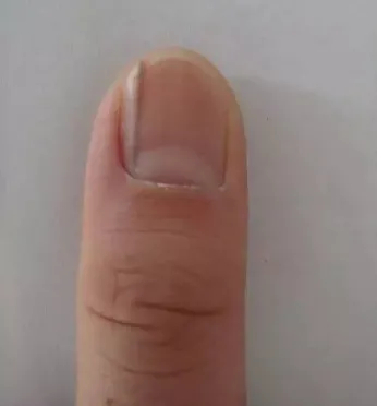 花生|小心指甲上出现的竖纹，这可能是体内器官病变的求救信号！