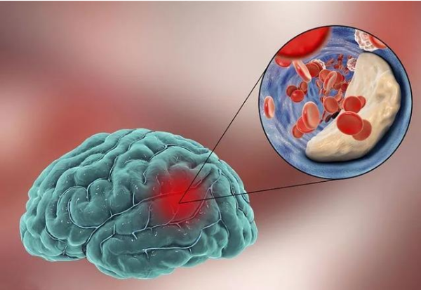 脑梗|脑梗不是悄无声息的，头部若有4个征兆，证明血管已“水泄不通”