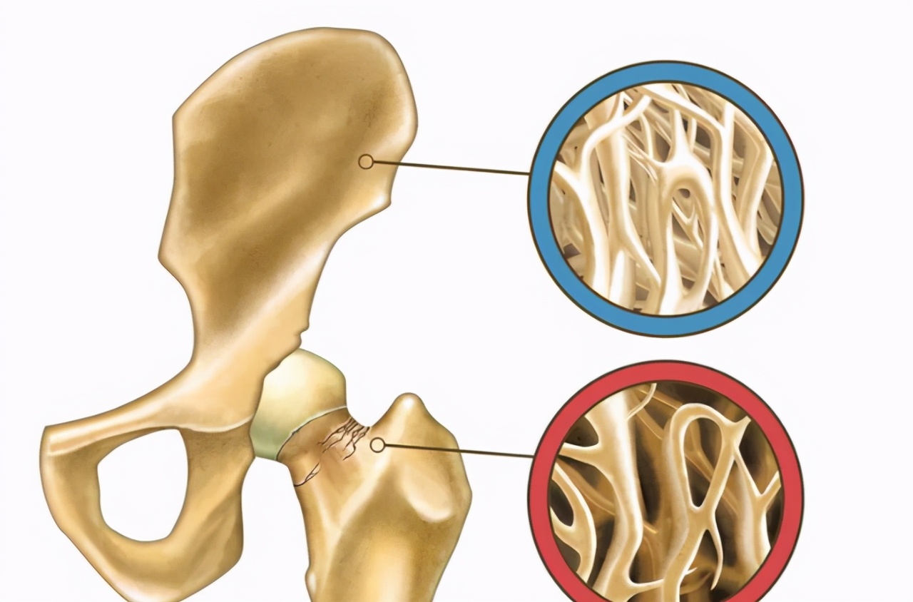 花椒|骨质疏松不能吃甜食?骨科医生:2物多吃,跟骨质疏松说“再见”