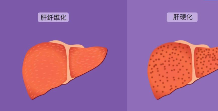 肝脏|肝脏出现纤维化时，身体会有4个信号，早发现早控制！
