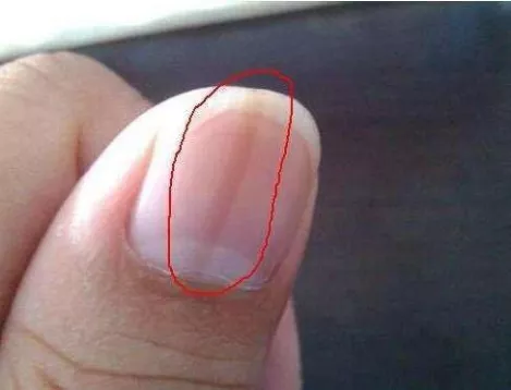 花生|小心指甲上出现的竖纹，这可能是体内器官病变的求救信号！