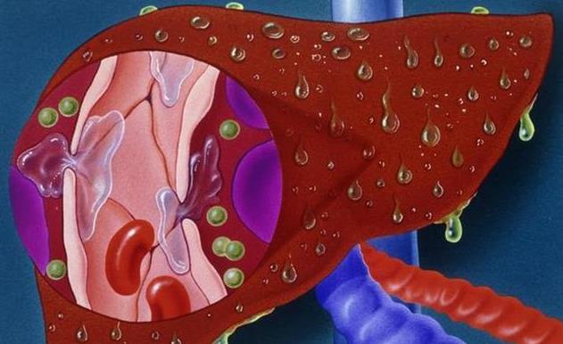 肝脏|肝脏出现纤维化时，身体会有4个信号，早发现早控制！