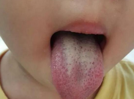 小小故事馆|5岁半女童脾胃坏死，儿科医生：3种食物孩子少碰，很伤脾胃