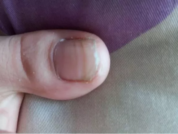 花生|小心指甲上出现的竖纹，这可能是体内器官病变的求救信号！