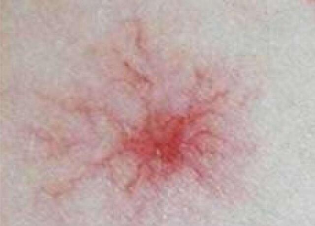 癌细胞|身体出现的3个“怪象”，可能是癌细胞正在敲门