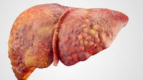 脂肪肝|26岁女子转氨酶高达2000，确诊肝硬化，医生：坚持1个习惯，肝毒净