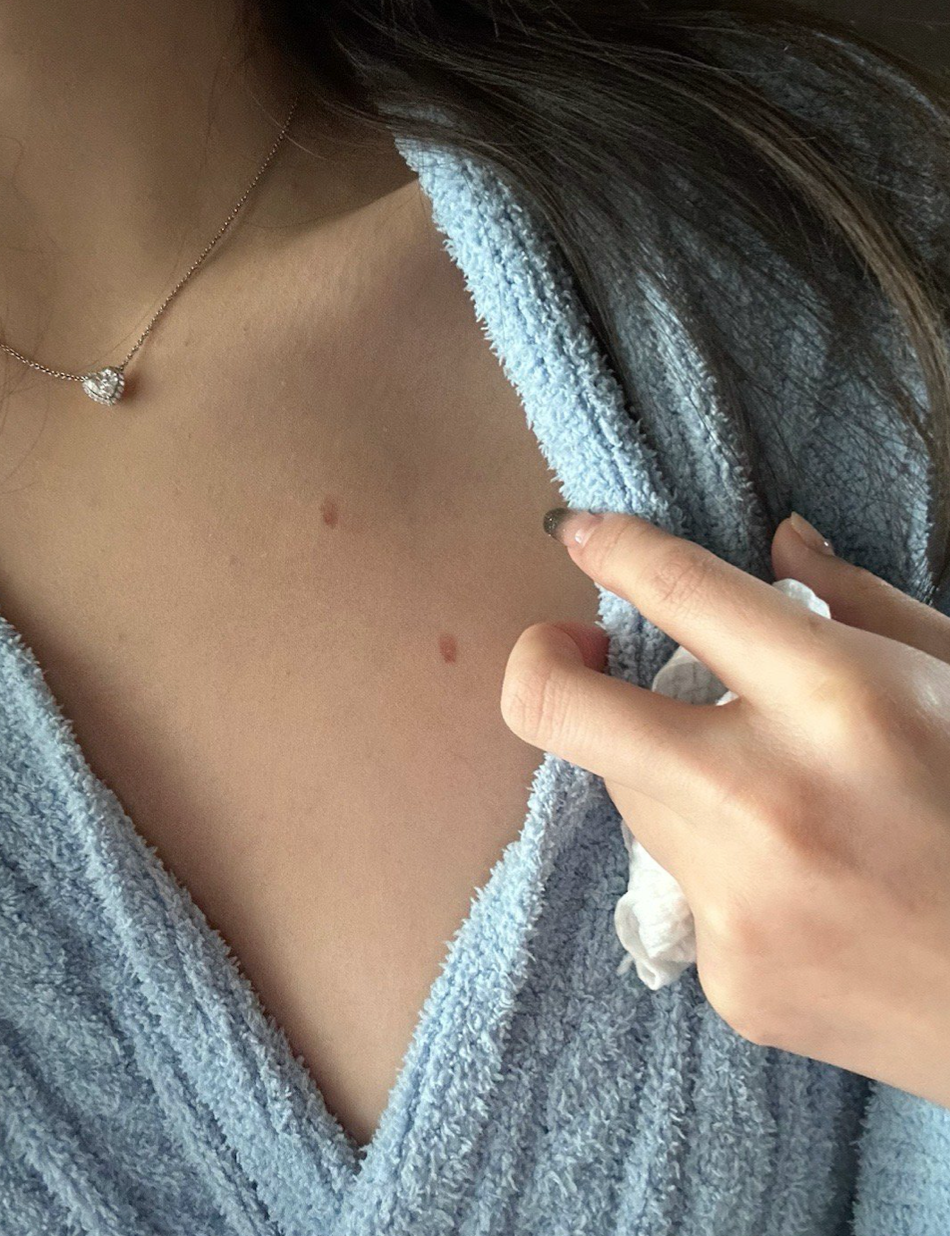 王思聪|王思聪女友:做饭被油烫伤,肌肤红润险些破相。拉开领口露胸前伤痕