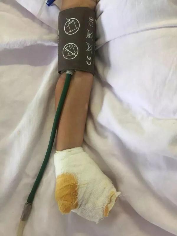 3岁女孩9根手指惨被切,醒来后痛哭:我想自己吃饭