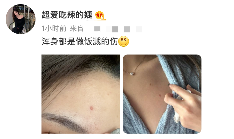 王思聪|王思聪女友:做饭被油烫伤,肌肤红润险些破相。拉开领口露胸前伤痕
