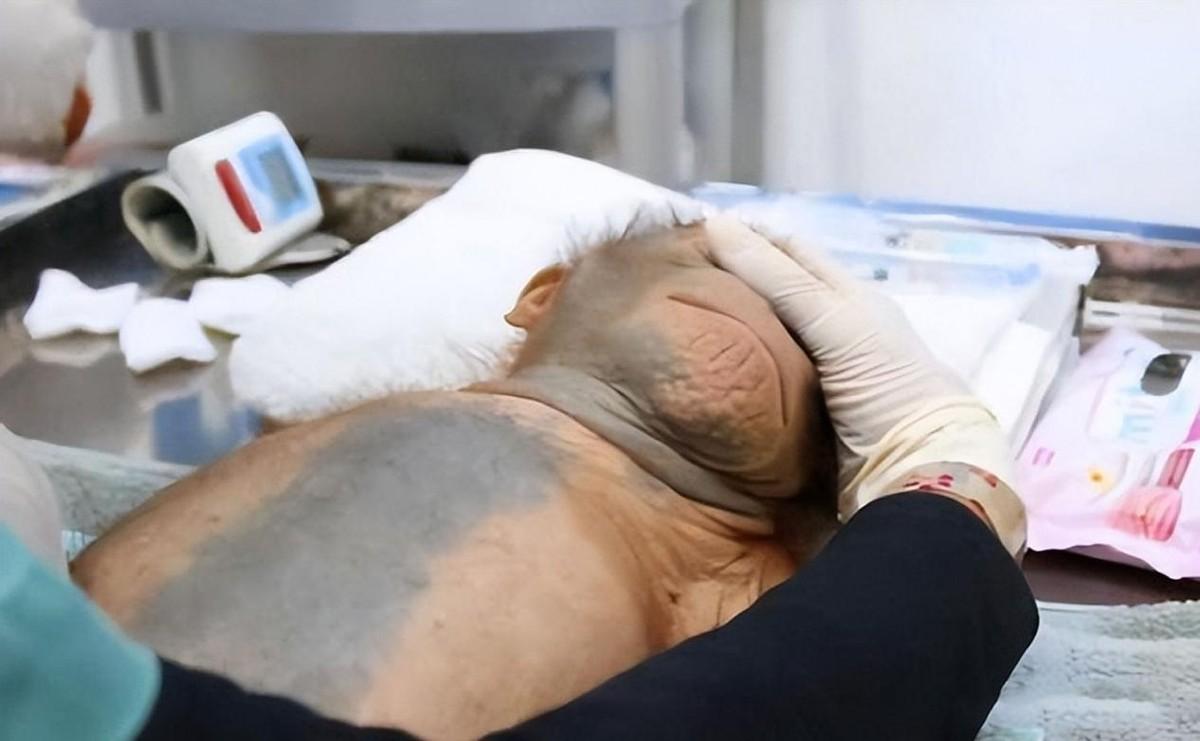 首例换头术,猴子换头后苏醒成功,一天后又被实施安乐死