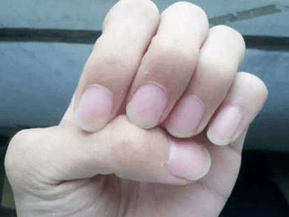 指甲出现这些或暗示癌症, 很多人都会忽略