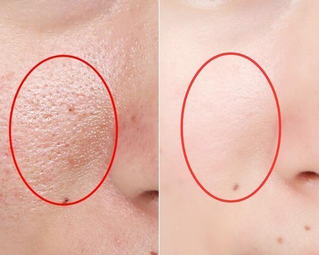 女人有螨虫脸就坑坑洼洼药店几块钱一包的粉末去螨虫皮肤变白嫩