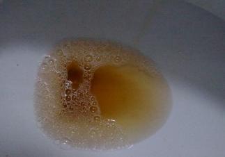 1,泡沫尿正常人的尿液一般为淡黄色,清晰透明.