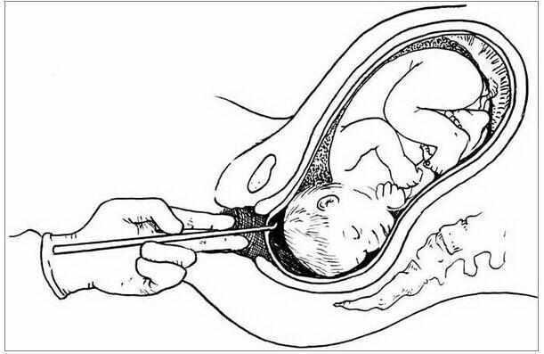 一胎儿子, 二胎怀上了女宝宝, 但却不得不做引产