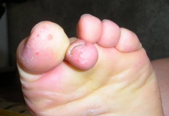 "香港脚"系真菌感染引起, 用蒲公英水可以治疗!