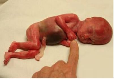 堕胎后的去死的胎儿遗体到底去哪了? 看完让人心痛