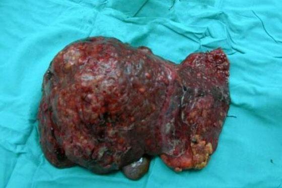 现在,越来越多的人有酒精肝,脂肪肝,甚至肝硬化,这和酒精自然脱不了干