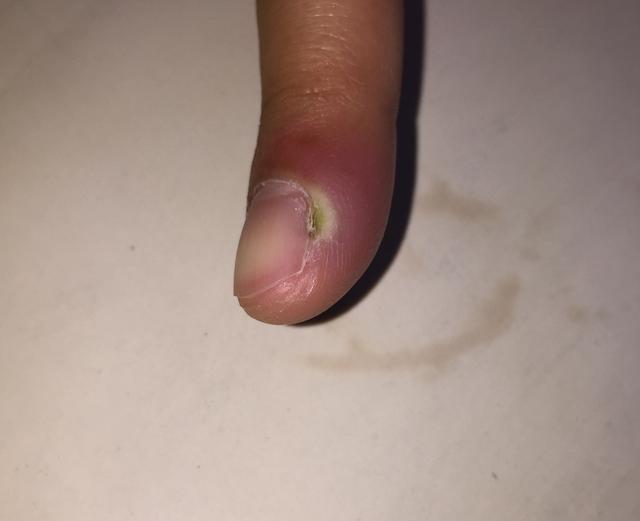 手上长倒刺不需要补充维生素