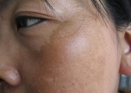 蝴蝶斑危害大, 去除有妙招!