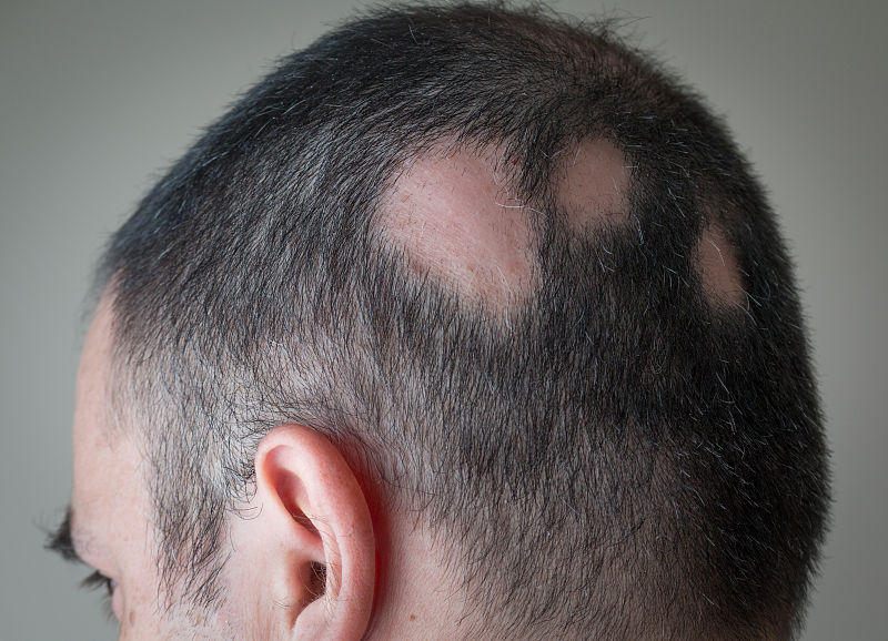 脱发|我国2亿人“秃了”，90后成为重灾区，到底是什么导致了脱发？