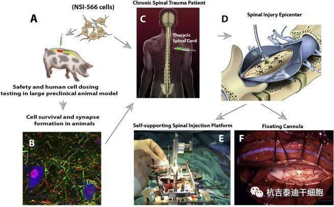 神经干细胞移植治疗慢性脊髓损伤的人体I期研究