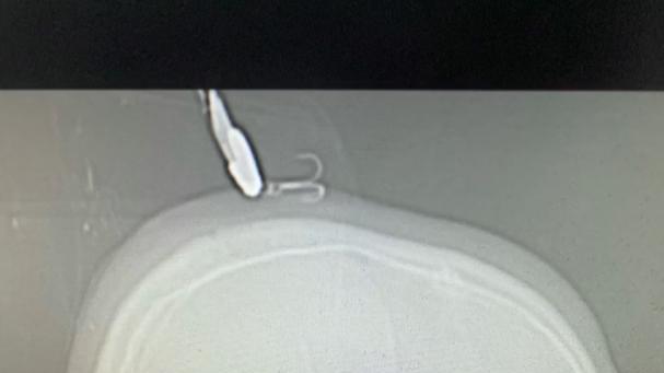 |操作失误，男子钓鱼不小心被鱼钩钩中头，网友调侃：钓鱼要戴头盔