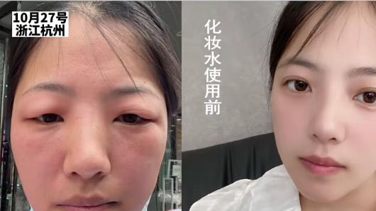 浙江萧山：女子用了一瓶化妆水，皮肤过敏双眼皮变单眼皮，张口索赔就是一万元