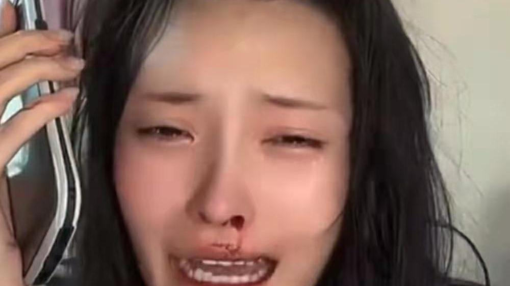 气愤！美女网红被男友暴打，满脸血边直播边报警，男友被扒是惯犯