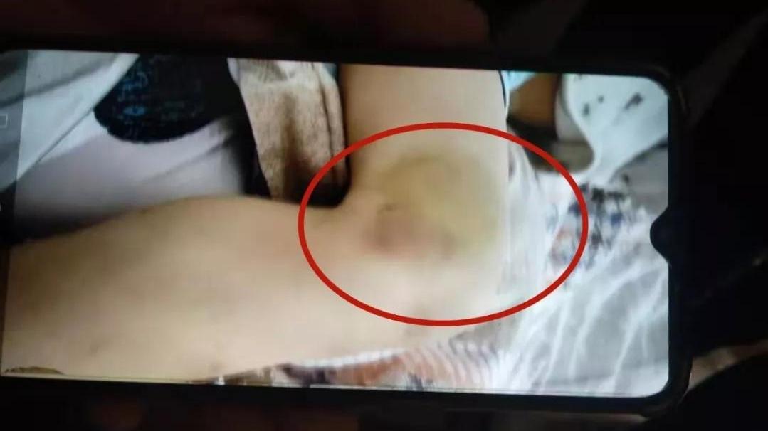 5岁男童被后妈虐待致死 警方回应：已对嫌疑人采取强制刑事措施