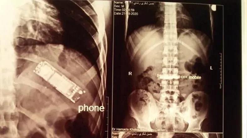 2021年他肚子疼被送进医院，结果照完X光发现里面有一部手机