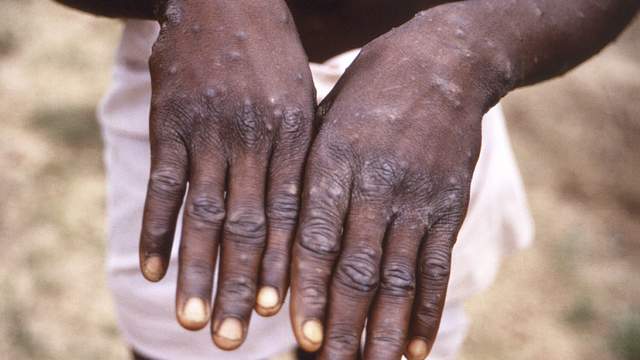 葡萄牙研究：猴痘病毒或加速进化发现约50基因变异