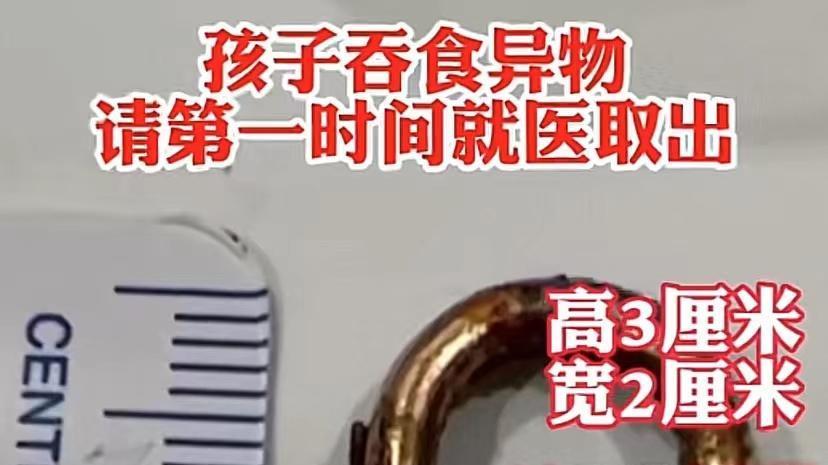 险失性命！五岁男孩吞食铜锁，父母指望自行排出九天未带其就医