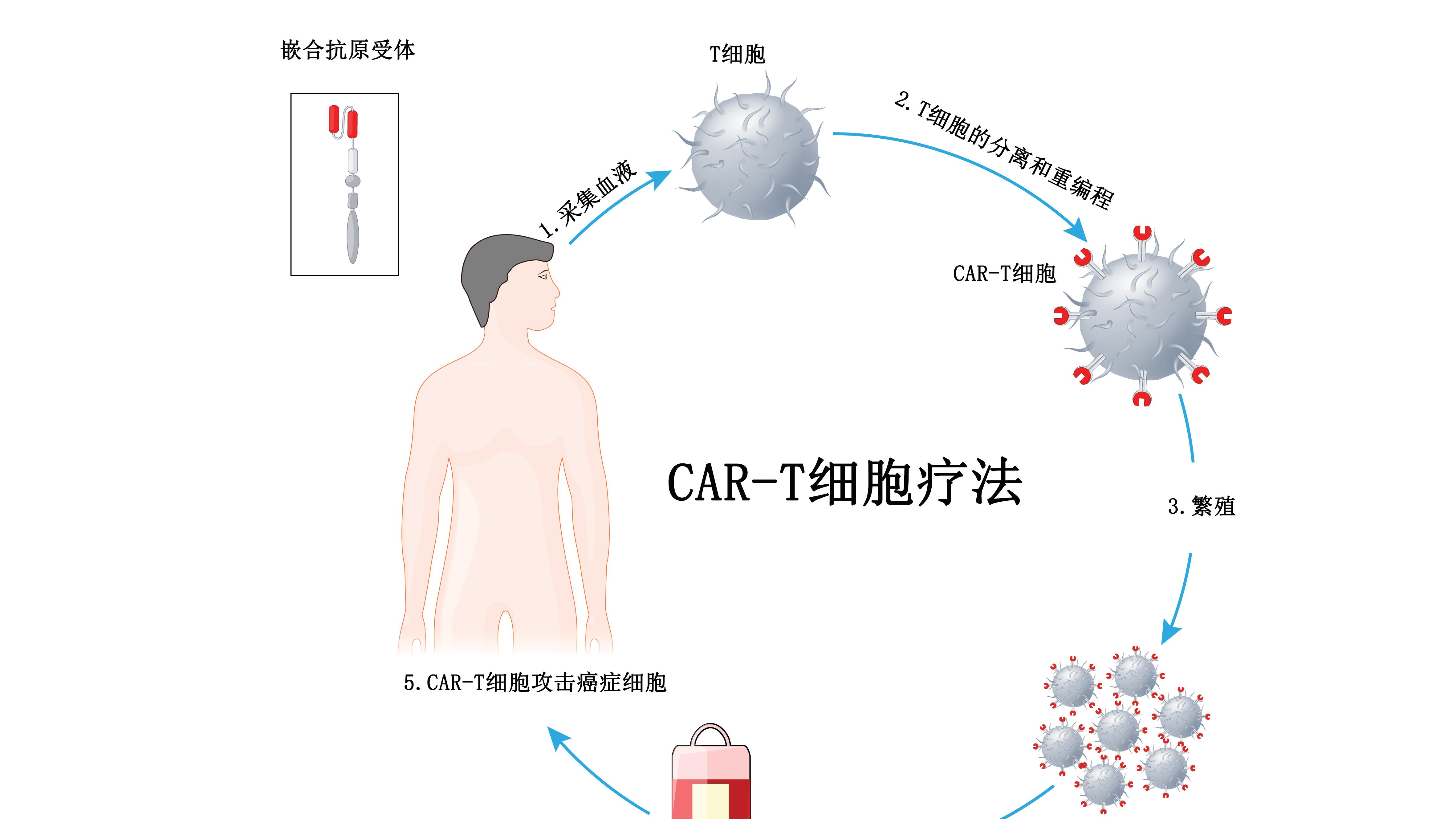 复发/难治性滤泡型淋巴瘤CAR-T细胞疗法Kymriah获FDA加速批准