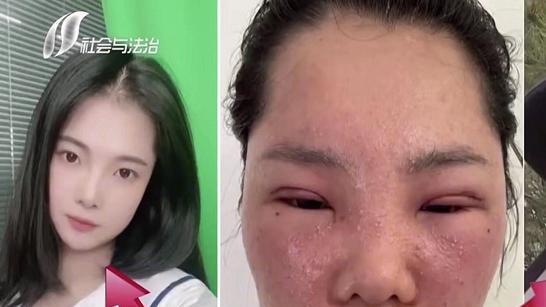 23岁妙龄女子割双眼皮变猪头，连母亲也认不出来，美容院拒绝赔偿