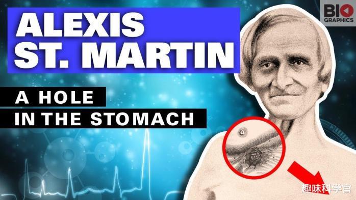 成就全人类的圣马丁：胃部骇人大洞，8年238次人体实验