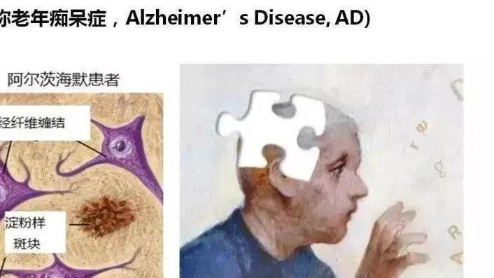 找回丢失的记忆，干细胞有望逆转阿尔茨海默病
