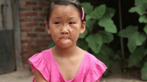 6岁女孩被妈妈夺走一张脸，每天哭求摘下“面具”，医生：作孽