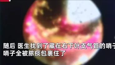 男子6岁时误吞哨子，怕被骂瞒了20年：害怕父母的孩子，有多可怜