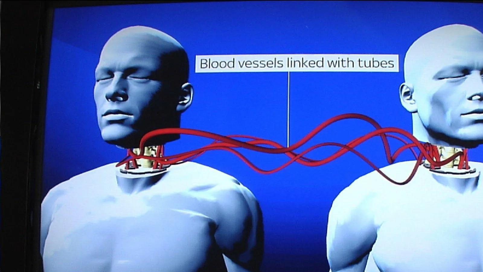 夺舍真的存在？脊髓移植手术后，长相、精液都在逐渐接近捐赠者