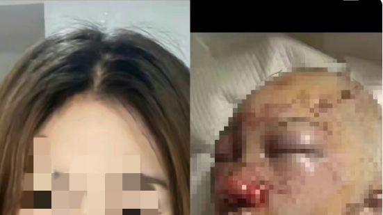 又一起“唐山打人案件”？20岁女孩去公共厕所被殴打毁容