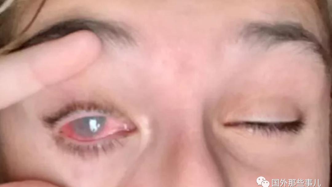13岁少女染发时染料喷入眼睛，左眼灼伤如今失明