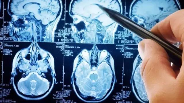 美国科学家实验室发现“人为的大脑切除术”