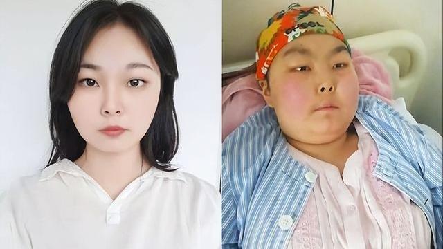 漂亮女大学生患病后容貌突变让人心疼，七旬爷爷为救孙女工地搬砖