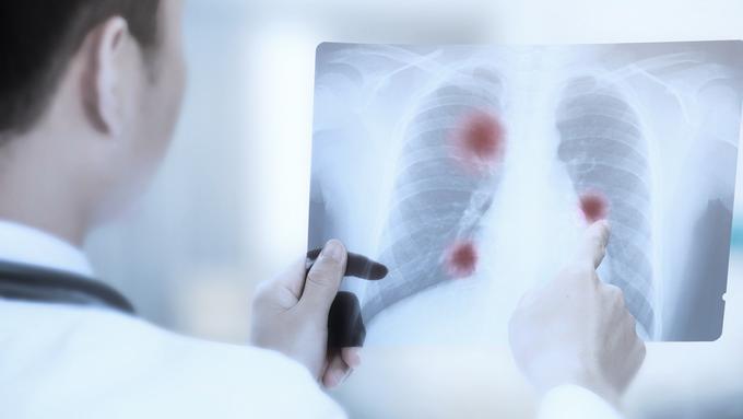 科学家找到引发肺癌主要原因！