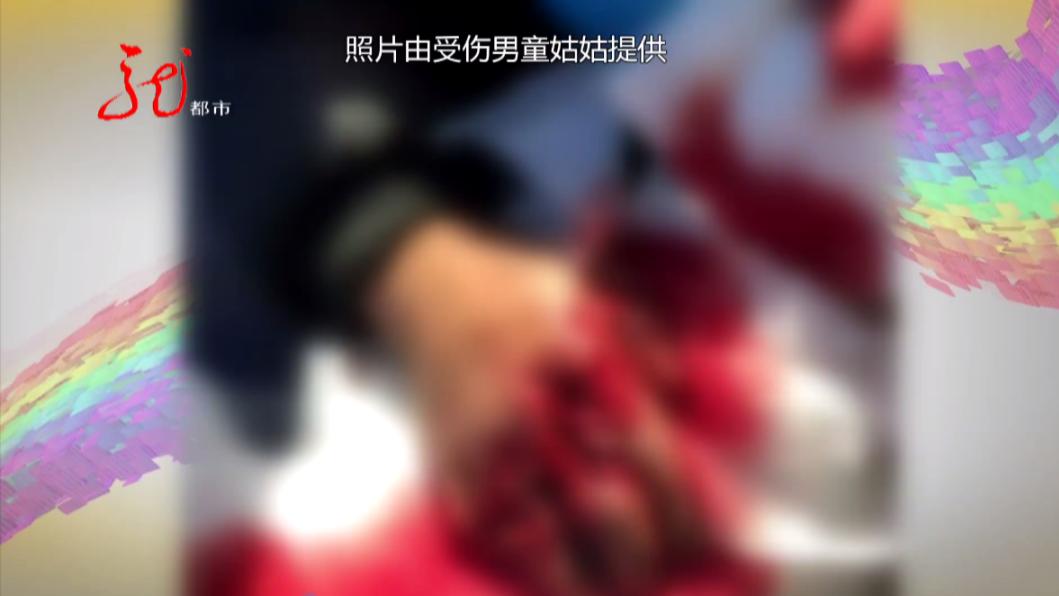 太心疼！只因一个大意，黑龙江6岁男孩5根手指全断了