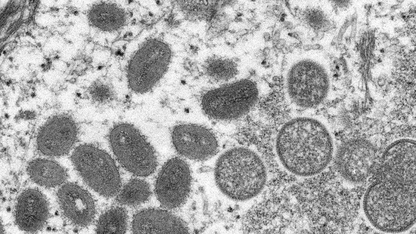 迪拜|越南发现首例猴痘病例 患者曾到迪拜旅游